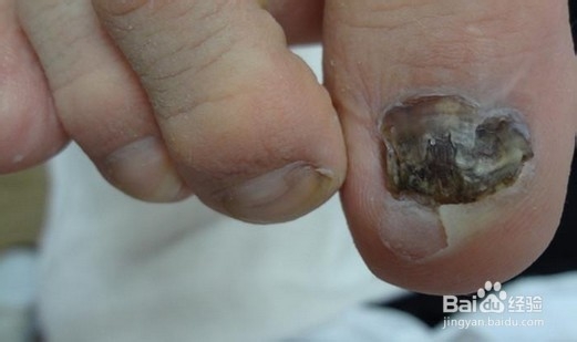 得了灰指甲的危害