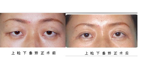 上睑下垂矫正术
