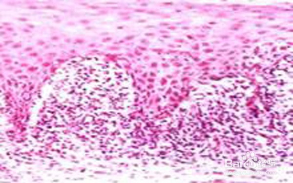 扁平苔藓症状哪些较常见