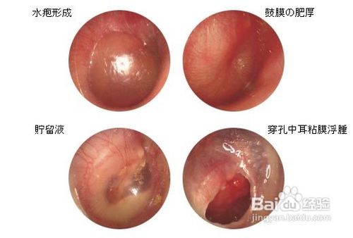 中耳炎手术后护理事项