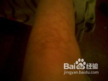 手脚冰凉怎么调理,女性别忽视小心带来的疾病