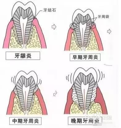 什么是深度洗牙