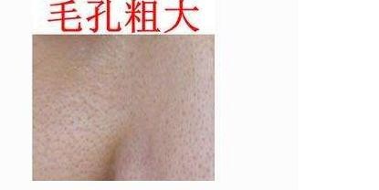 油性皮肤毛孔粗大怎么办