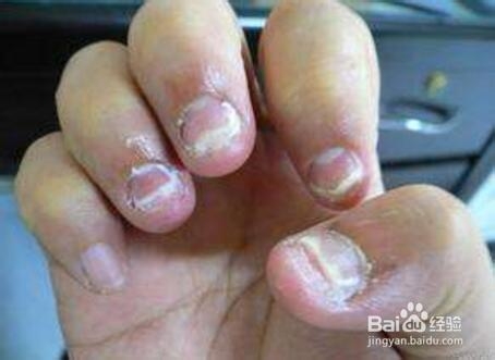教你怎么治灰指甲