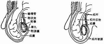 带你认识常见病：[17]腹外疝