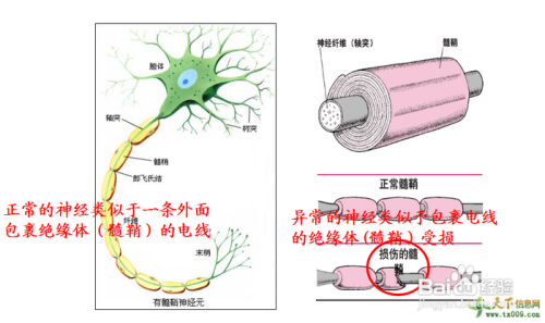 脱髓鞘应该怎么办?