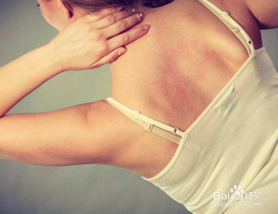 治疗湿疹用什么药膏好?怎么治疗湿疹比较好?