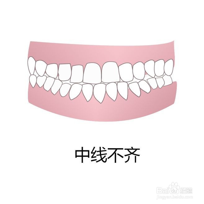 牙齿矫正类型图片