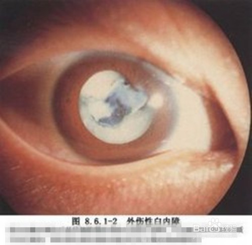 中老年人的白内障手术什么时候做最合适？