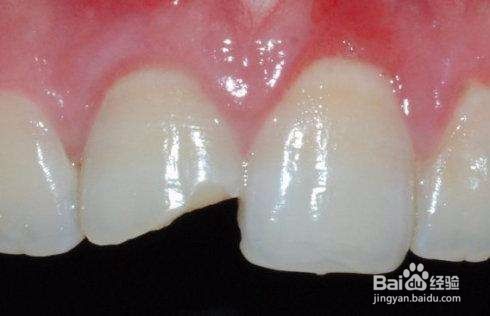 牙齿酸痛怎么办