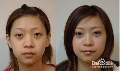 割双眼皮手术过程中会有明显的疼痛感吗