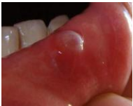 经常口腔溃疡是什么原因和治疗方法。
