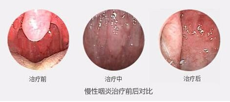 橘红青果茶专治咽炎喉咙痛,多年的慢性咽炎好了