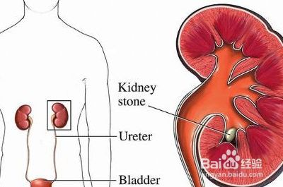 如何早期发现痛风