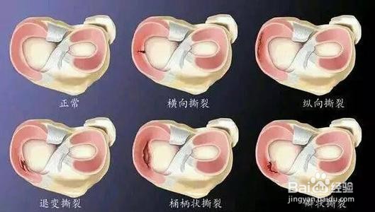 半月板损伤的症状都有什么