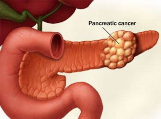 【警惕】这4种腹泻是癌症的报警信号！