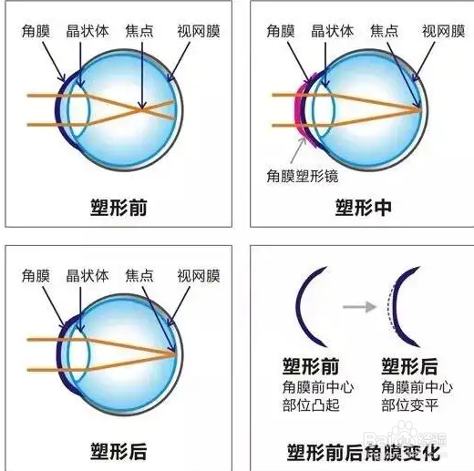 如何控制近视