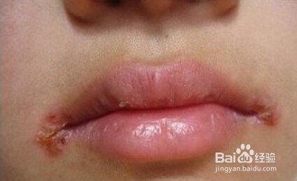 口角炎怎么治愈呢