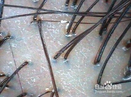 脂溢性脱发简单便宜又好用的生发方法