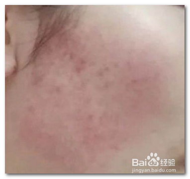 角质层薄怎么修复