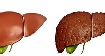 如何预防肝硬化