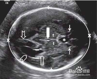 孕检出现唐筛高危、肾盂增宽异常等情况怎么办？