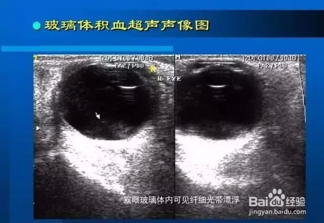 几种常见眼病B超图谱及诊断