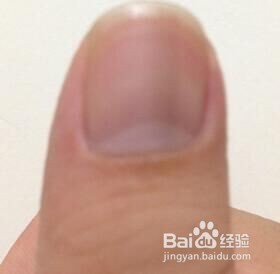 老年人“青筋”凸起什么缘故呢