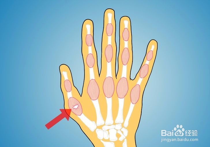 如何诊断拇指是否骨折?