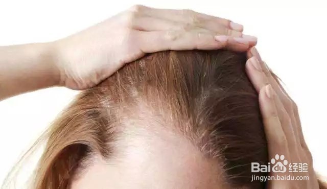 三步教你摆脱产后脱发