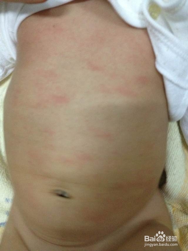 痱子和湿疹的区别