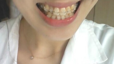 牙齿矫正方法有哪些